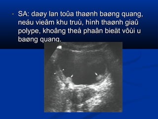 - SA: daøy lan toûa thaønh baøng quang,SA: daøy lan toûa thaønh baøng quang,
neáu vieâm khu truù, hình thaønh giaûneáu vieâm khu truù, hình thaønh giaû
polype, khoâng theå phaân bieät vôùi upolype, khoâng theå phaân bieät vôùi u
baøng quang.baøng quang.
 