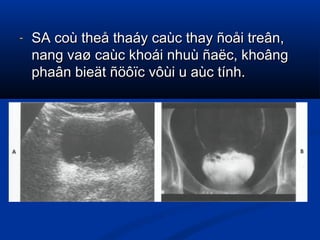 - SA coù theå thaáy caùc thay ñoåi treân,SA coù theå thaáy caùc thay ñoåi treân,
nang vaø caùc khoái nhuù ñaëc, khoângnang vaø caùc khoái nhuù ñaëc, khoâng
phaân bieät ñöôïc vôùi u aùc tính.phaân bieät ñöôïc vôùi u aùc tính.
 