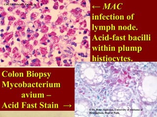 CDC/Dr. Edwin P. Ewing, Jr.
← MAC
infection of
lymph node.
Acid-fast bacilli
within plump
histiocytes.
Colon Biopsy
Mycobacterium
avium –
Acid Fast Stain → © Dr. Peter Anderson, University of Alabama at
Birmingham, Dept of Path.
 
