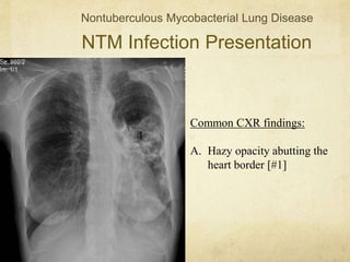 NTM Infection Presentation
Nontuberculous Mycobacterial Lung Disease
Common CXR findings:
A. Hazy opacity abutting the
heart border [#1]
1
 