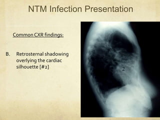 CommonCXR findings:
B. Retrosternal shadowing
overlying the cardiac
silhouette [#2]
NTM Infection Presentation
2
 