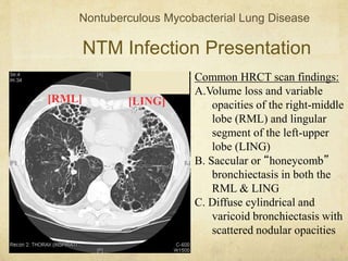 NTM Infection Presentation
Nontuberculous Mycobacterial Lung Disease
Common HRCT scan findings:
A.Volume loss and variable
opacities of the right-middle
lobe (RML) and lingular
segment of the left-upper
lobe (LING)
B. Saccular or “honeycomb”
bronchiectasis in both the
RML & LING
C. Diffuse cylindrical and
varicoid bronchiectasis with
scattered nodular opacities
[RML] [LING]
 
