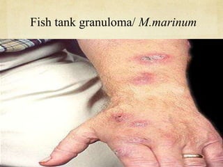 Fish tank granuloma/ M.marinum
 