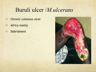 Buruli ulcer /M.ulcerans
Chronic cutanous ulcer
Africa mostly
Debridment
 