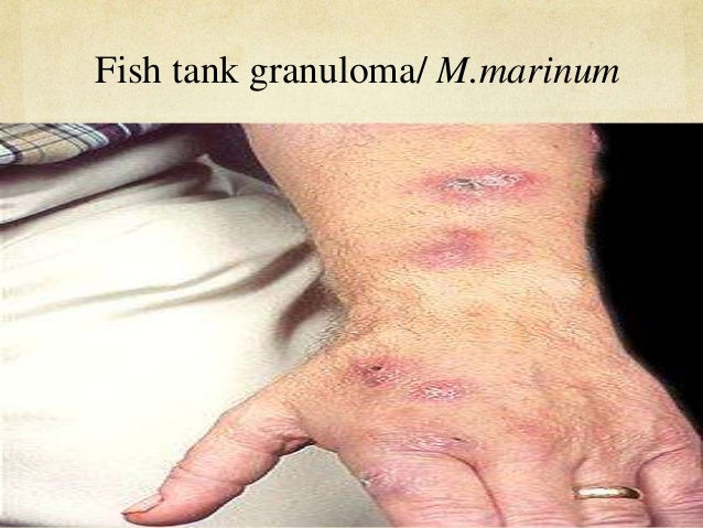 ATYPICAL MYCOBACTERIA