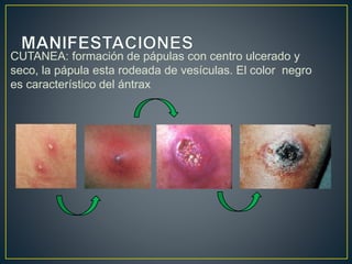 ÁNTRAX | PPTX