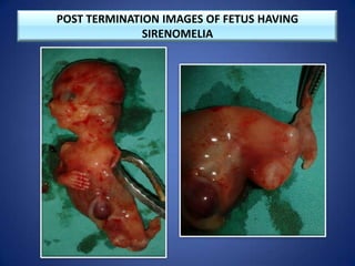 POST TERMINATION IMAGES OF FETUS HAVING
SIRENOMELIA
 