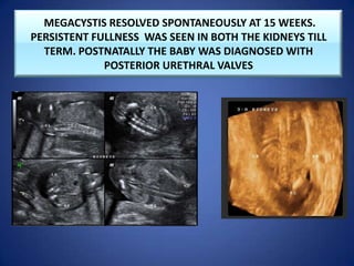 MEGACYSTIS RESOLVED SPONTANEOUSLY AT 15 WEEKS.
PERSISTENT FULLNESS WAS SEEN IN BOTH THE KIDNEYS TILL
TERM. POSTNATALLY THE BABY WAS DIAGNOSED WITH
POSTERIOR URETHRAL VALVES
 