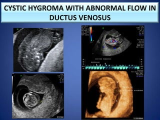 CYSTIC HYGROMA WITH ABNORMAL FLOW IN
DUCTUS VENOSUS
 
