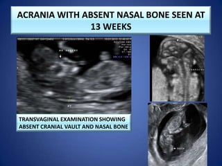 ACRANIA WITH ABSENT NASAL BONE SEEN AT
13 WEEKS
TRANSVAGINAL EXAMINATION SHOWING
ABSENT CRANIAL VAULT AND NASAL BONE
 