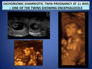 DICHORIONIC-DIAMNIOTIC TWIN PREGNANCY AT 11 WKS
– ONE OF THE TWINS SHOWING ENCEPHALOCELE
 