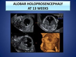 ALOBAR HOLOPROSENCEPHALY
AT 13 WEEKS
 