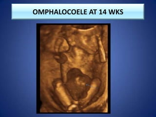 OMPHALOCOELE AT 14 WKS
 