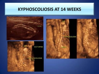 KYPHOSCOLIOSIS AT 14 WEEKS
 