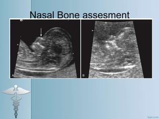 Nasal Bone assesment
 