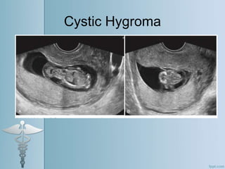 Cystic Hygroma
 