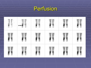 Perfusion
Perfusion
 