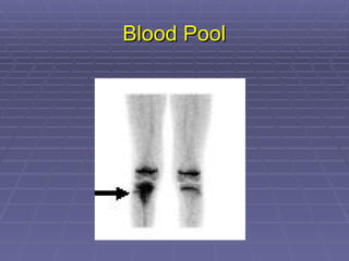 Blood Pool
Blood Pool
 