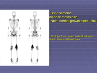 •Bone sarcoma:
Bone sarcoma:
no bone metastasis
no bone metastasis
•Note: normal growth plate uptake
Note: normal growth plate uptake
•Findings: focal uptake in distal left femur
Findings: focal uptake in distal left femur
due to known osteosarcoma
due to known osteosarcoma
 