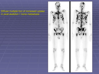 Diffuse multiple foci of increased uptake
Diffuse multiple foci of increased uptake
in axial skeleton = bone metastasis
in axial skeleton = bone metastasis
 