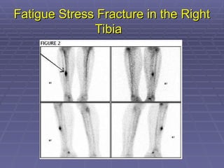 Fatigue Stress Fracture in the Right
Fatigue Stress Fracture in the Right
Tibia
Tibia
 