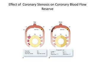 Effect of Coronary Stenosis on Coronary Blood Flow
Reserve
 