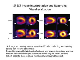 SPECT Image Interpretation and Reporting
Visual evaluation
A, A large, moderately severe, reversible IW defect reflecting a moderately
severe flow reserve abnormality
B, A milder reversible IW defect reflecting a less severe stenosis or a severe
stenosis with well-developed collaterals minimizing the defect severity
In both patients, there is also a mild lateral wall reversible defect
 