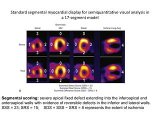 Standard segmental myocardial display for semiquantitative visual analysis in
a 17-segment model
Segmental scoring: severe apical fixed defect extending into the inferoapical and
anteroapical walls with evidence of reversible defects in the inferior and lateral walls.
SSS = 23; SRS = 15; SDS = SSS − SRS = 8 represents the extent of ischemia
 