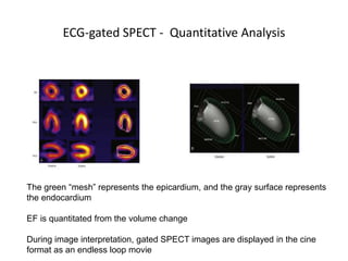 ECG-gated SPECT - Quantitative Analysis
The green “mesh” represents the epicardium, and the gray surface represents
the endocardium
EF is quantitated from the volume change
During image interpretation, gated SPECT images are displayed in the cine
format as an endless loop movie
 