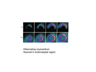 HIbernating myocardium
Scarred in anteroseptal region
 