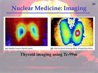 86
Nuclear Medicine: Imaging
Thyroid imaging using Tc-99m
 