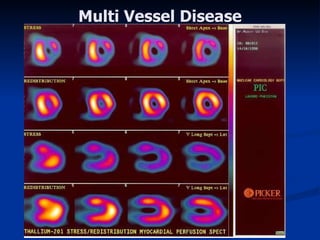 Multi Vessel Disease 