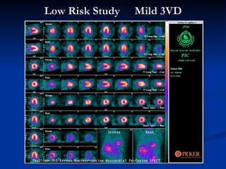 Low Risk Study  Mild 3VD 
