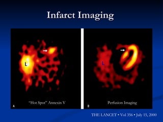 Infarct Imaging  “ Hot Spot” Annexin V Perfusion Imaging THE LANCET • Vol 356 • July 15, 2000 