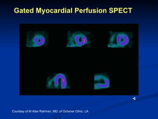 Gated Myocardial Perfusion SPECT Courtesy of M Atiar Rahman, MD, of Ochsner Clinic. LA 