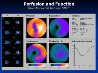 Perfusion and Function Gated Myocardial Perfusion SPECT 