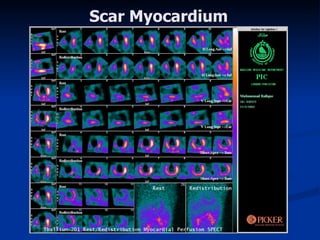 Scar Myocardium 