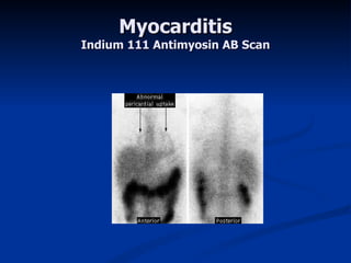 Myocarditis Indium 111 Antimyosin AB Scan 