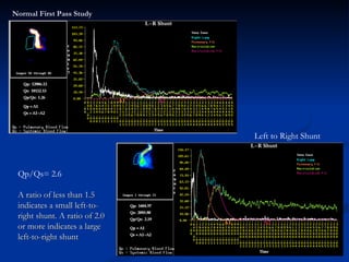 Normal First Pass Study Left to Right Shunt Qp/Qs= 2.6 A ratio of less than 1.5 indicates a small left-to-right shunt. A ratio of 2.0 or more indicates a large left-to-right shunt 