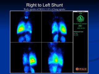 Right to Left Shunt Body uptake of MAA > 6% of lung uptake 
