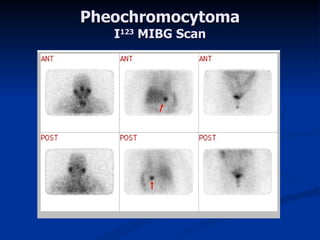 Pheochromocytoma I 123  MIBG Scan 