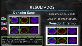 CD4
Dapi
JAK3
Localización nuclear de
JAK3 en los linfocitos CD4.
Cada celda está representada con y sin núcleo
Dapi y, con y sin etiquetado CD4 para visualizar
mejor la presencia de JAK3 en el núcleo y
citoplasma.
 