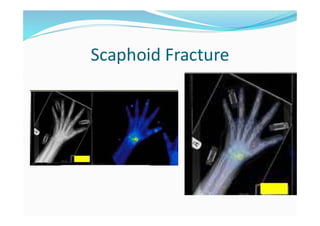 Scaphoid Fracture
 