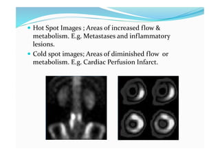  Hot Spot Images ; Areas of increased flow &
metabolism. E.g. Metastases and inflammatory
lesions.
 Cold spot images; Areas of diminished flow or
metabolism. E.g. Cardiac Perfusion Infarct.
 
