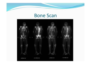 Bone Scan
 