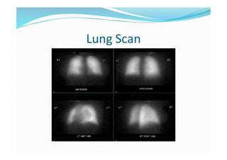Lung Scan
 