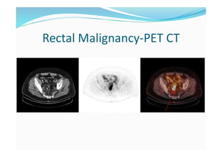 Rectal Malignancy-PET CT
 