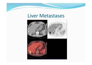 Liver Metastases
 