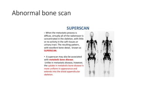 Abnormal bone scan
 