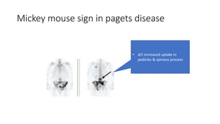 Mickey mouse sign in pagets disease
• d/t increased uptake in
pedicles & spinous process
 